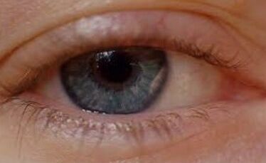 Oculax ha curato la blefarite